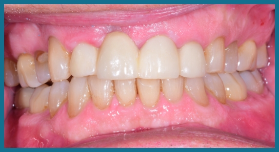 Smile after dental treatment