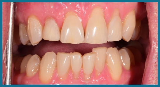 Smile after dental treatment