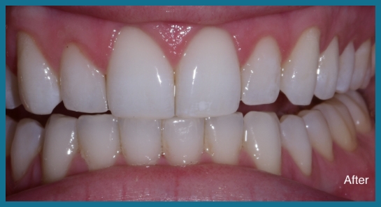 Smile after dental treatment