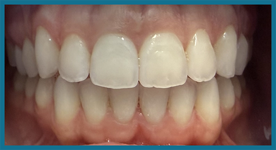 Smile with more evenly aligned teeth