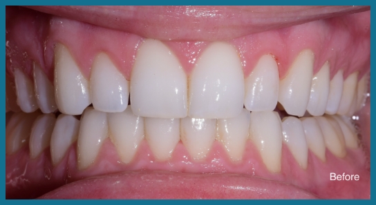 smile before dental treatment