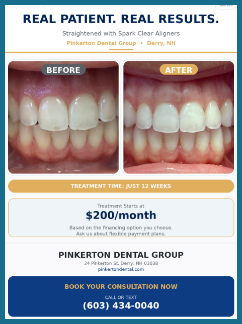 before and after of patient wearing Spark clear aligners