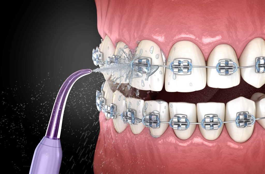 A CGI of a water flosser cleaning teeth with braces